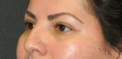Blepharoplasty Before & After Patient #12438