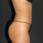 Liposuction Before & After Patient #12451