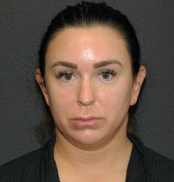 Liposuction Before & After Patient #12472