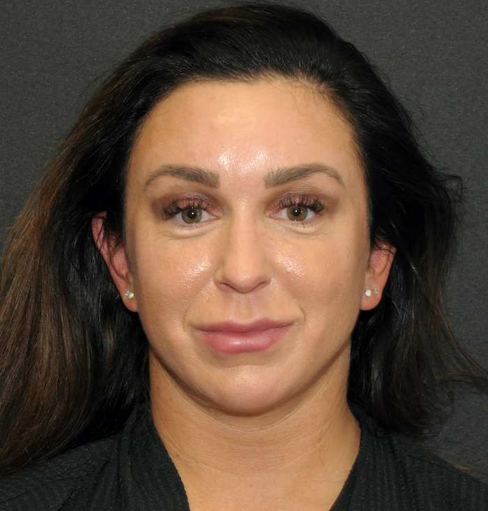 Liposuction Before & After Patient #12472