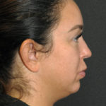 Liposuction Before & After Patient #12472