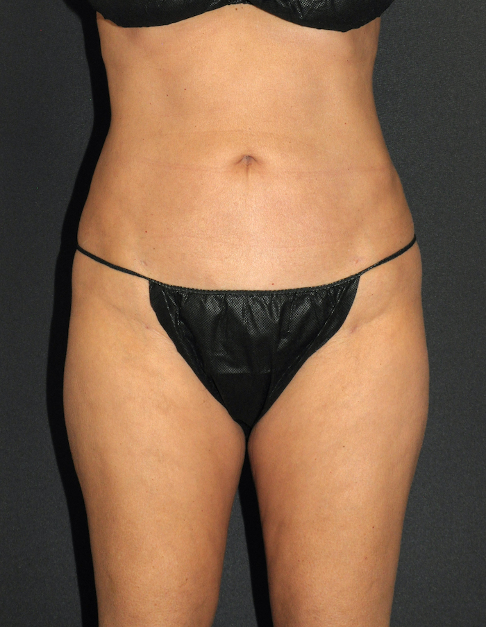 Liposuction Before & After Patient #12483
