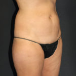 Liposuction Before & After Patient #12483