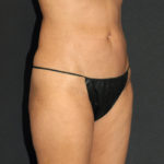 Liposuction Before & After Patient #12483