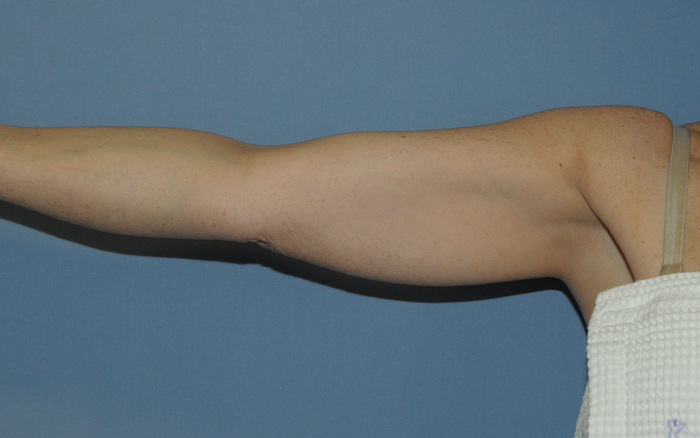 Liposuction Before & After Patient #12500