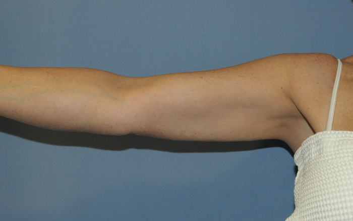 Liposuction Before & After Patient #12500