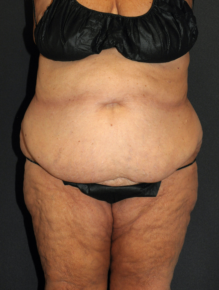 Liposuction Before & After Patient #12517