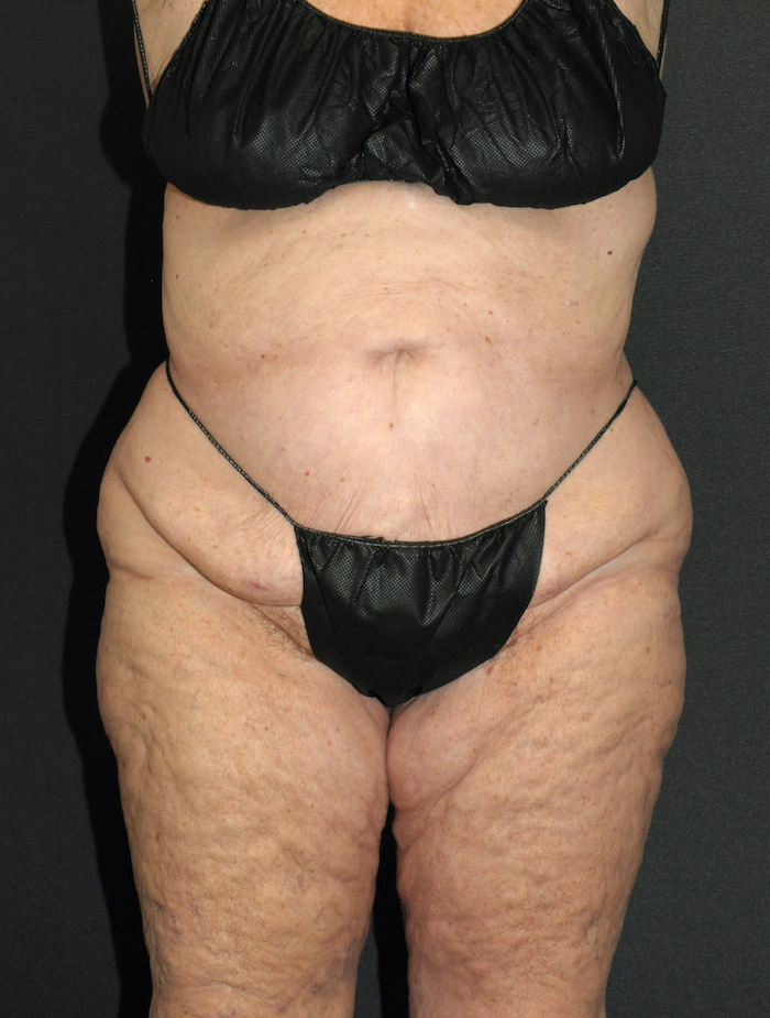 Liposuction Before & After Patient #12517