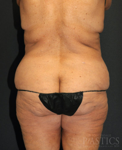 Liposuction Before & After Patient #12517