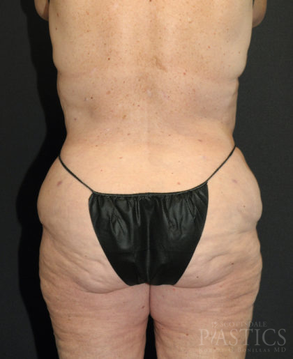 Liposuction Before & After Patient #12517
