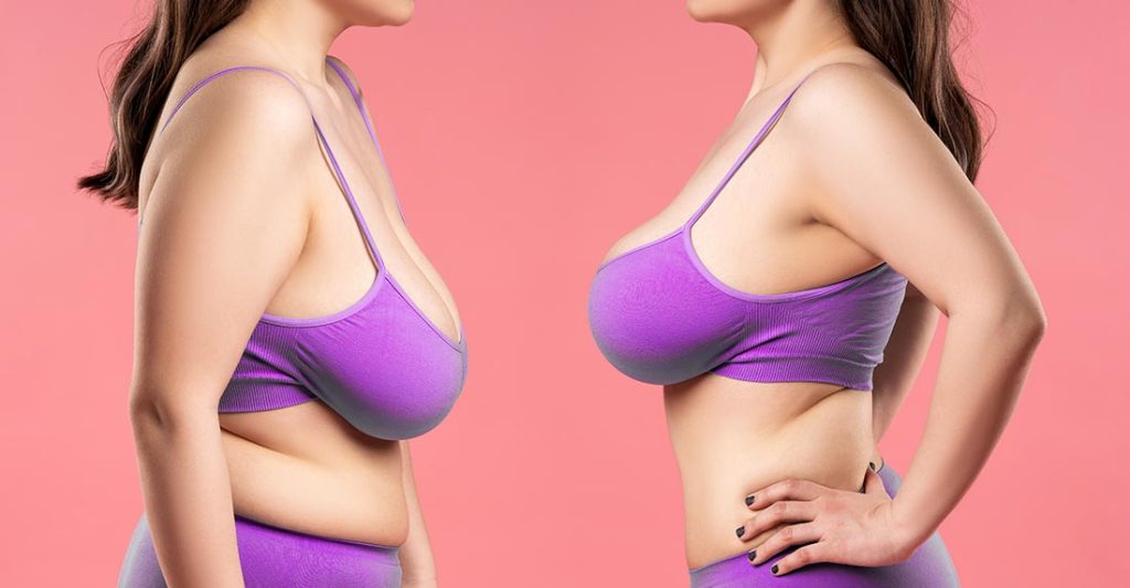 Breast augmentation sagging firm comparison.  Scottsdale Plastics