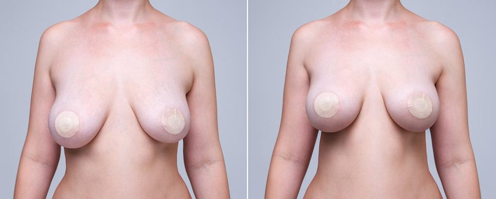 Before and after breast lift well lit.  Scottsdale Plastics.